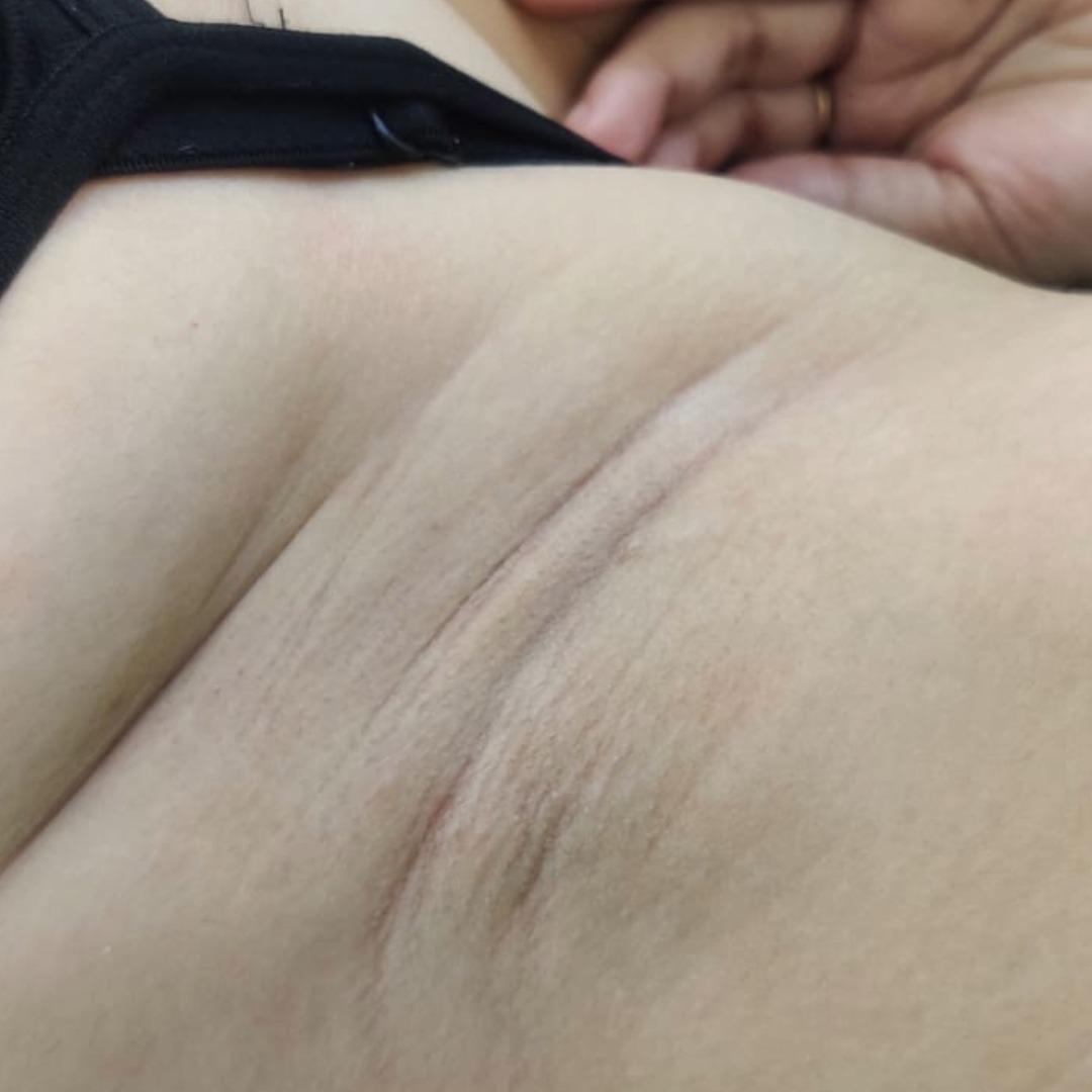 After laser hair removal